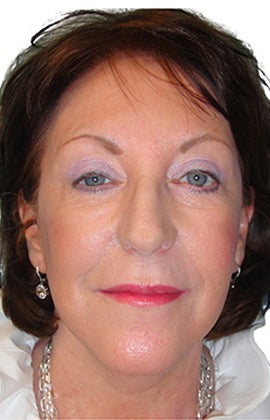 Facelift, necklift, upper & lower blepharoplasty after 526457