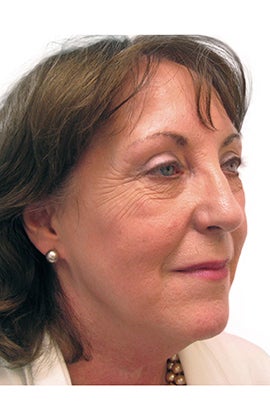 Facelift, necklift, upper & lower blepharoplasty 526457