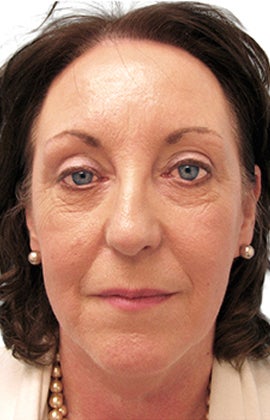 Facelift, necklift, upper & lower blepharoplasty before 526457