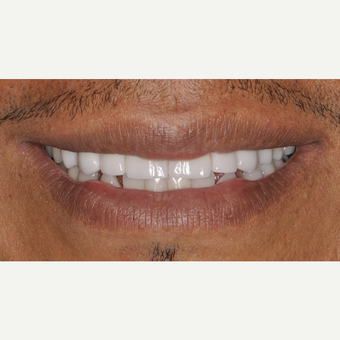 35-44 year old man treated with Porcelain Veneers after 3537395