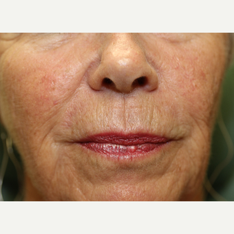 65-74 year old woman treated with Chemical Peel before 3837240