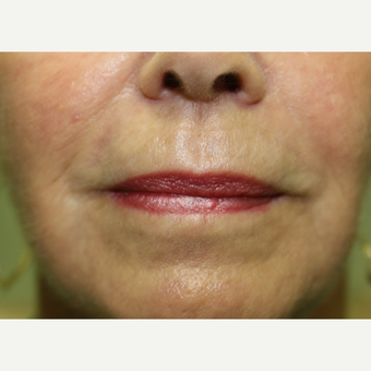65-74 year old woman treated with Chemical Peel after 3837240