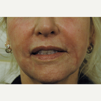 Remove Smoker's Lines, Fractional Laser Resurfacing Los Angeles after 2746271