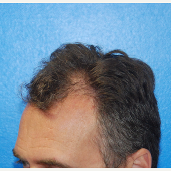 45-54 year old man treated with FUE Hair Transplant before 3604020