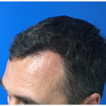 45-54 year old man treated with FUE Hair Transplant after 3604020