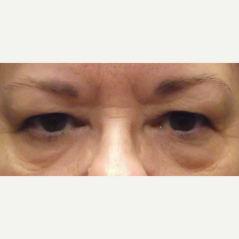 55-64 year old woman treated with Eyelid Surgery before 3482821