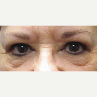 55-64 year old woman treated with Eyelid Surgery after 3482821