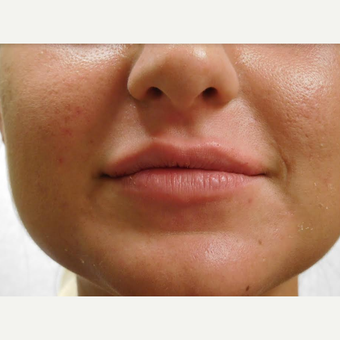 25-34 year old woman treated with Lip Augmentation before 3440962