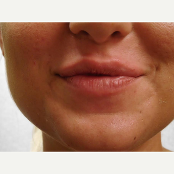 25-34 year old woman treated with Lip Augmentation after 3440962