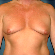 50 year old man treated with Male Breast Reduction before 3720891
