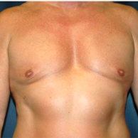 50 year old man treated with Male Breast Reduction after 3720891