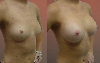 Breast Implants before 974254
