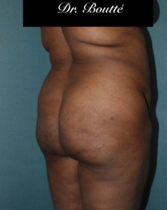 29 year old woman treated with Fat Transfer to Buttocks & Hips. SmartLipo to Abdomen, Flanks, & Back 1811395