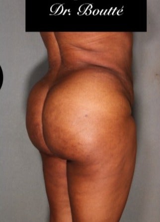 29 year old woman treated with Fat Transfer to Buttocks & Hips. SmartLipo to Abdomen, Flanks, & Back 1811395