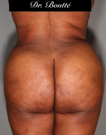 29 year old woman treated with Fat Transfer to Buttocks & Hips. SmartLipo to Abdomen, Flanks, & Back after 1811395