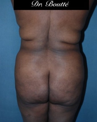 29 year old woman treated with Fat Transfer to Buttocks & Hips. SmartLipo to Abdomen, Flanks, & Back before 1811395