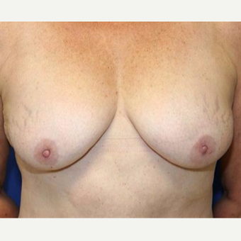 35-44 year old woman treated with Breast Lift before 3037136