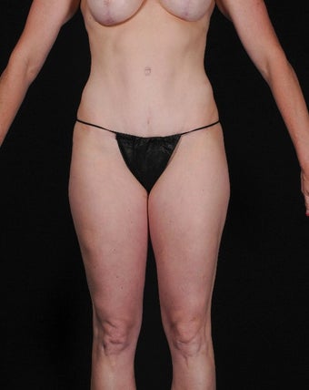35-44 year old woman treated with SAFELipo after 3126432
