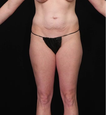 35-44 year old woman treated with SAFELipo before 3126432