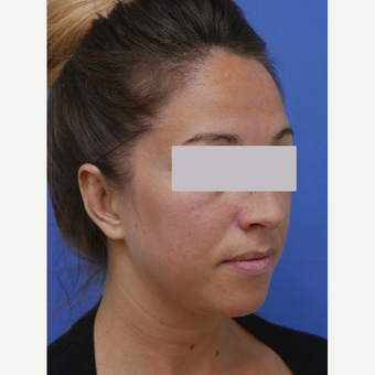 Young lady underwent ear "pinning" procedure after 3345603