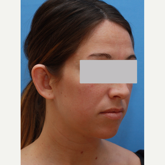 Young lady underwent ear "pinning" procedure before 3345603