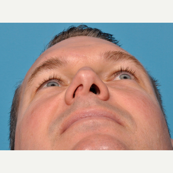 Correction to Severe Deviated Septum before 3583148
