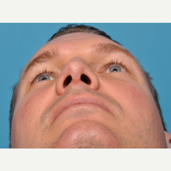 Correction to Severe Deviated Septum after 3583148