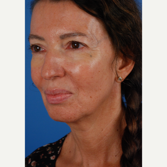 55-64 year old woman treated with Lower Face Lift, chin implant and upper eyelid surgery before 3663156