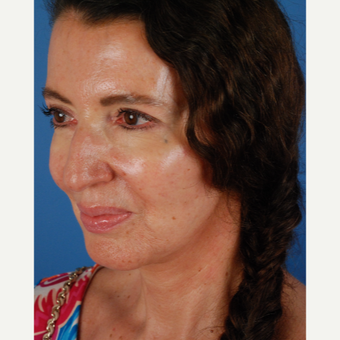 55-64 year old woman treated with Lower Face Lift, chin implant and upper eyelid surgery after 3663156