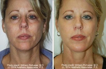 Neck Lift, Neck Lipo, Chin Implant before 212303