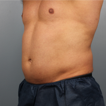 35-44 year old man treated with CoolSculpting before 3507238