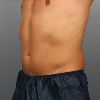 35-44 year old man treated with CoolSculpting after 3507238