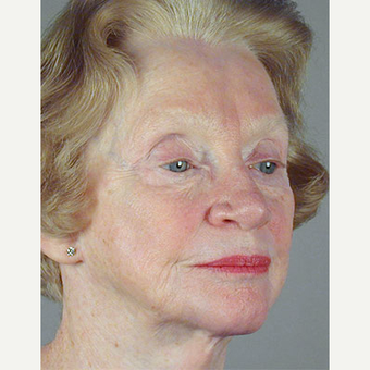 65-74 year old woman treated with Facelift before 3213554