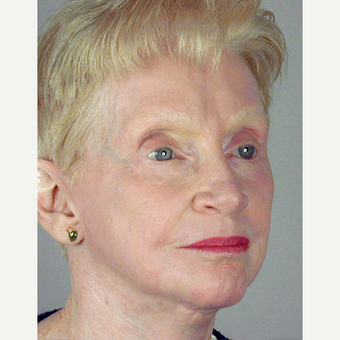 65-74 year old woman treated with Facelift after 3213554
