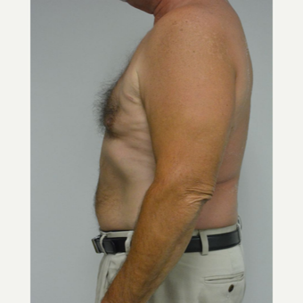 55-64 year old man treated with Male Breast Reduction after 3054054