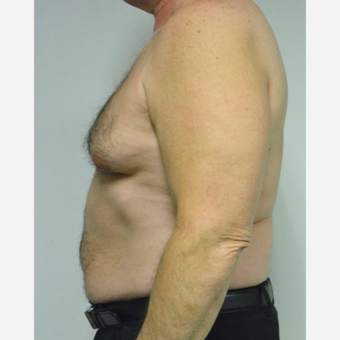 55-64 year old man treated with Male Breast Reduction before 3054054