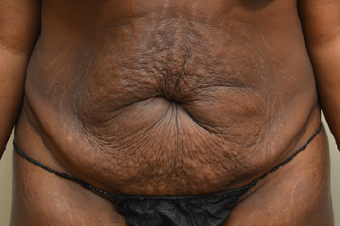 35-44 year old woman treated with Mommy Makeover before 3837073