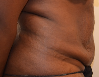 35-44 year old woman treated with Mommy Makeover 3837073