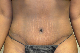 35-44 year old woman treated with Mommy Makeover after 3837073