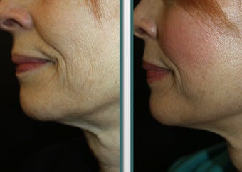 UpLift - a local anesthesia facelift before 1065289