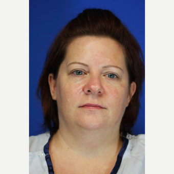 35-44 year old woman treated with Chin Liposuction before 3376959