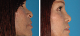 Revision Rhinoplasty before 1208279