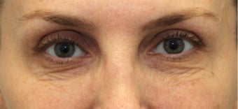 lower blepharoplasty with fat grafting and laser resurfacing before 3166902
