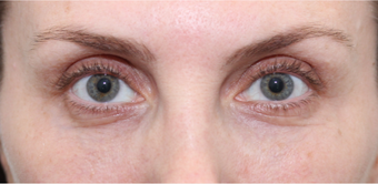 lower blepharoplasty with fat grafting and laser resurfacing after 3166902