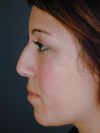 Female Chin Implant before 831842