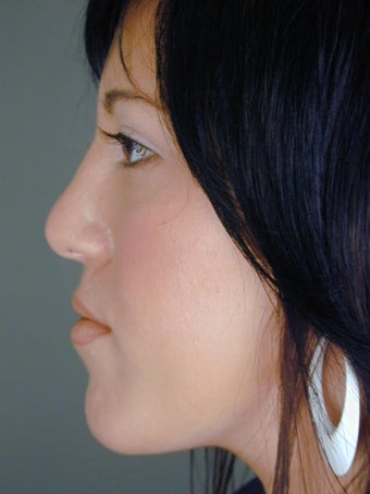 Female Chin Implant after 831842
