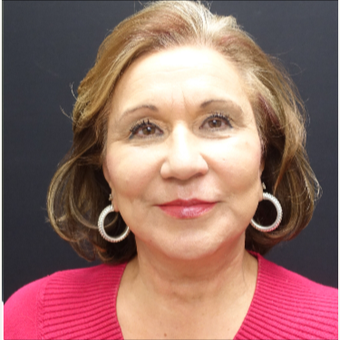 65-74 year old woman treated with Neck Lift after 3244905