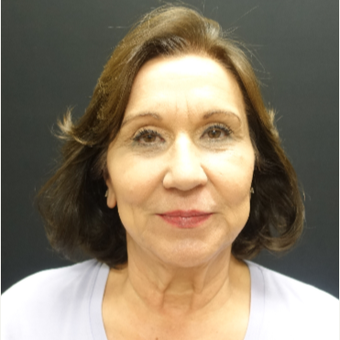 65-74 year old woman treated with Neck Lift before 3244905