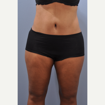 45-54 year old woman treated with Tummy Tuck after 3590346
