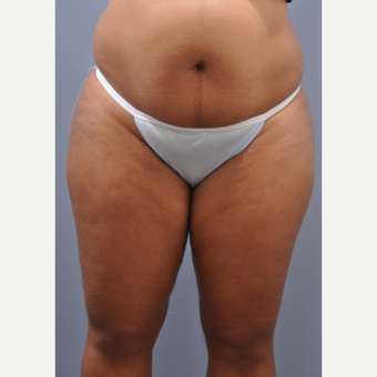 45-54 year old woman treated with Tummy Tuck before 3590346